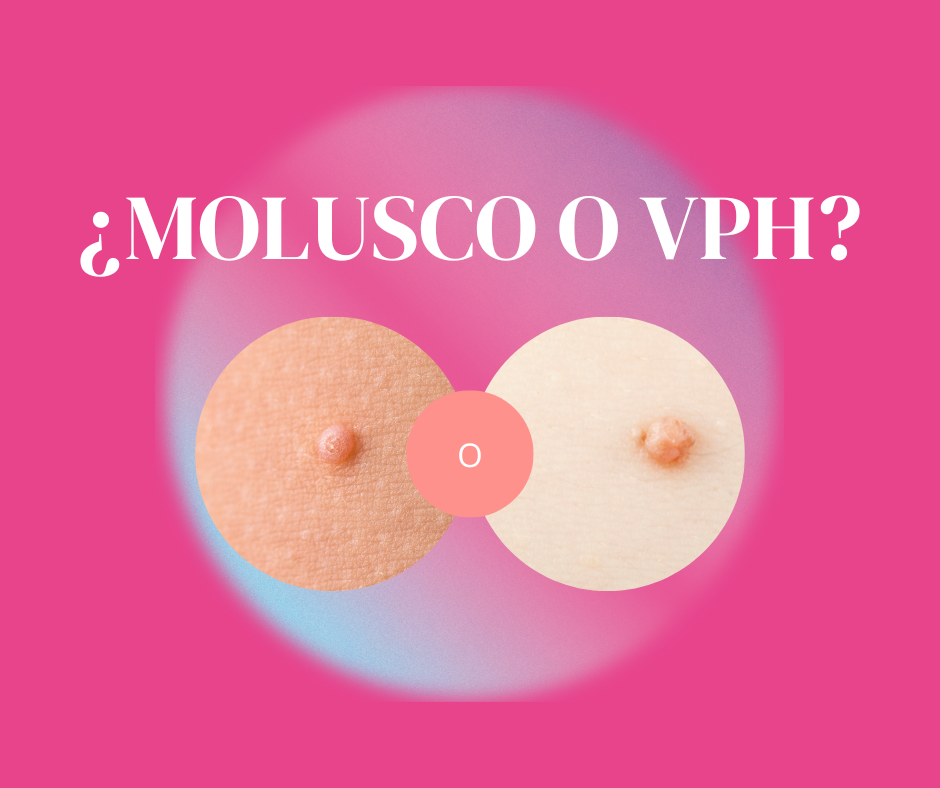 Molusco contagioso y el VPH, diferencias y similitudes.